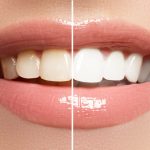Perfect,Smile,Before,And,After,Bleaching.,Dental,Care,And,Whitening